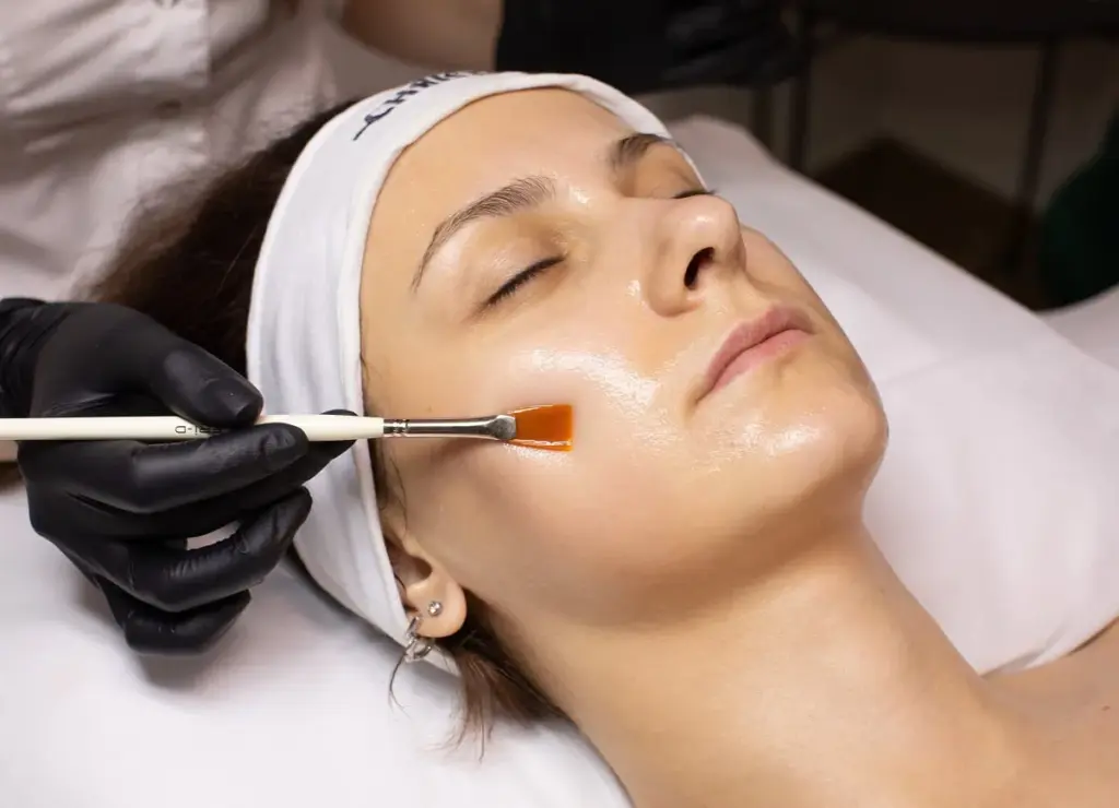 Portfolio 1 Chemical Peels Treatment in Elk Grove CA
