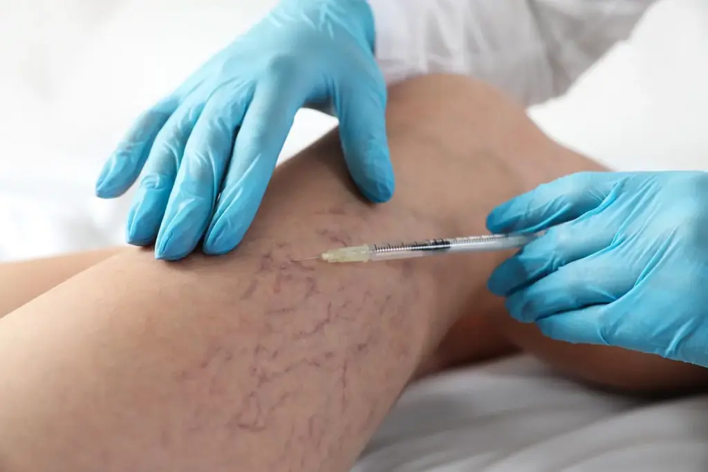 Portfolio 11 Spider Vein Treatment in Elk Grove