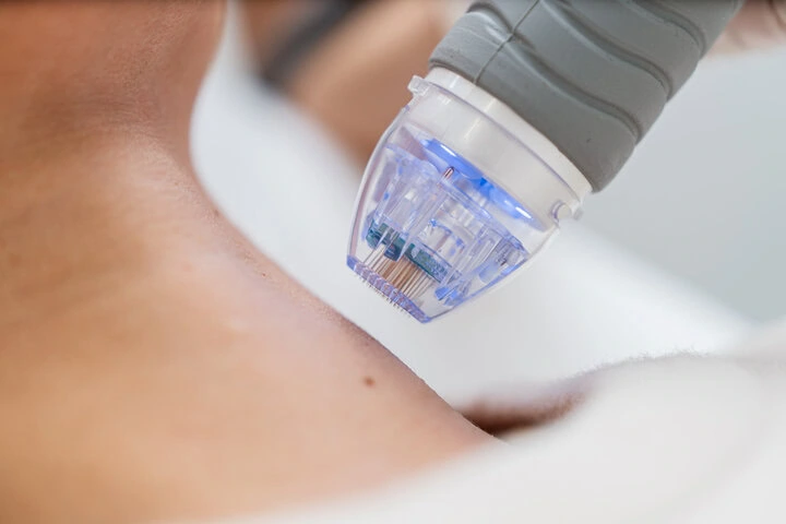 A Guide to Microneedling on the West Coast Unlocking Your Skins Natural Radiance