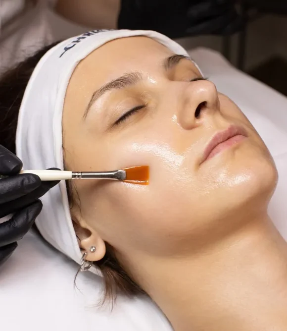 Chemical-Peels-Treatment-in-Elk-Grove-CA